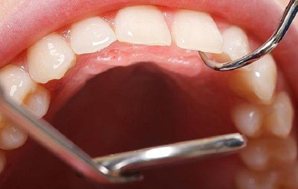 Las personas con periodontitis tendrían mayor riesgo de padecer hipertensión