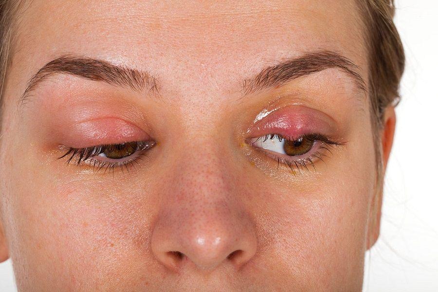 Blefaritis: Qué es, síntomas, causas, complicaciones, diagnóstico y tratamiento