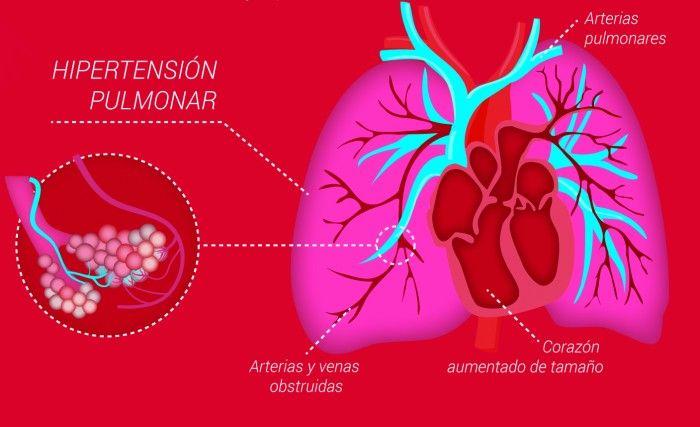 Buenos Aires congrega a expertos de todo el mundo en Hipertensión Arterial Pulmonar
