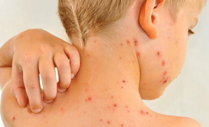 El sarampión produce ´amnesia inmune´ y deja al cuerpo expuesto a infecciones