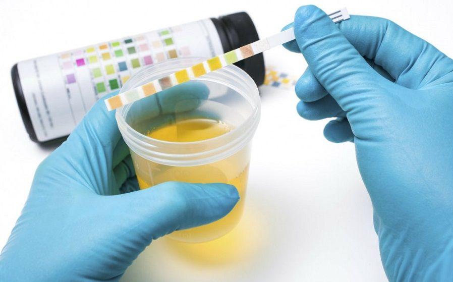 Desarrollan un test de orina para detectar cáncer de cuello uterino