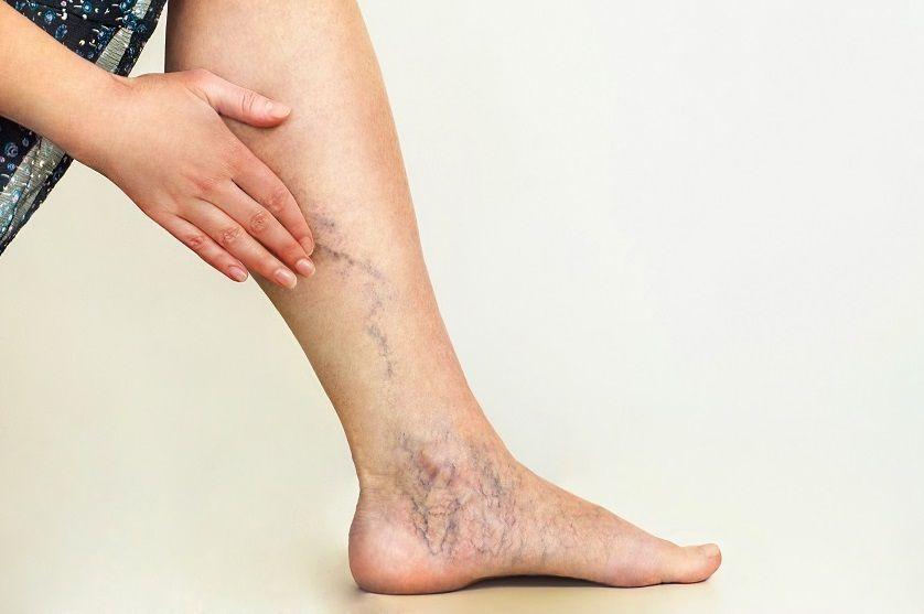 Insuficiencia venosa crónica: causas, síntomas, exámenes y tratamiento
