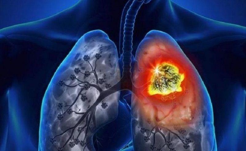 Retirarían del PMO una droga que reduce el riesgo de muerte por cáncer de pulmón