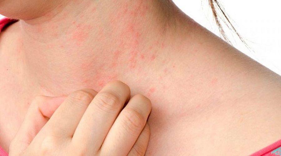Avance en el tratamiento de infecciones de la piel por hongos y parásitos