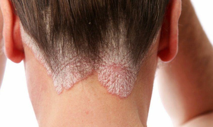 Psoriasis: cómo evitar el impacto psicológico, social y laboral