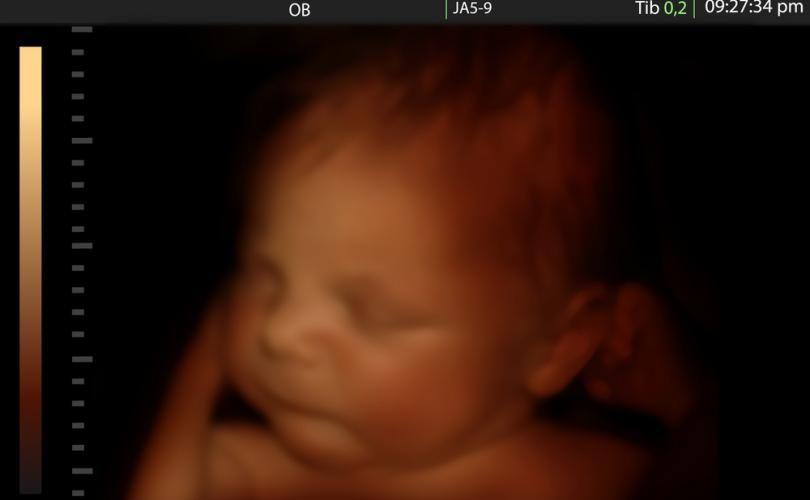 ¿Próxima generalización del aborto tardío en Francia?