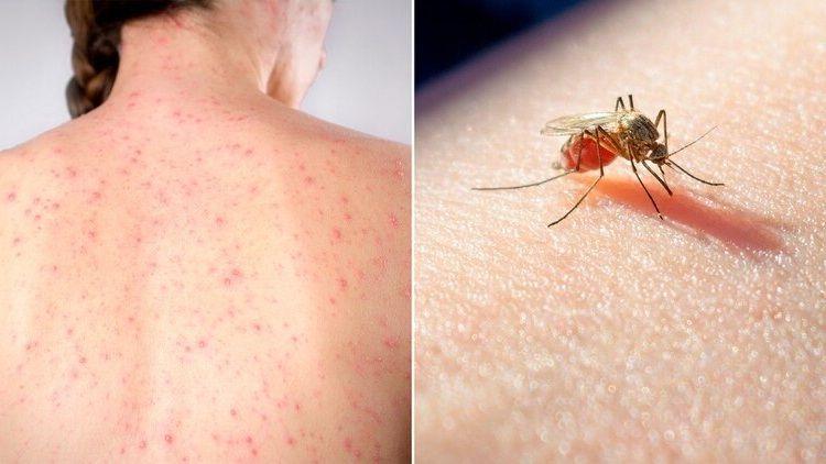 Emiten recomendaciones ante los 2 fallecidos confirmados por dengue y sarampión en Buenos Aires