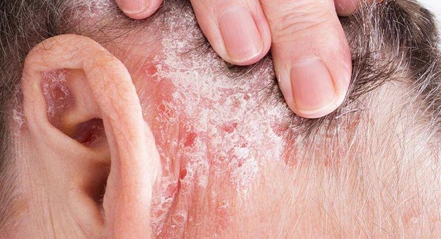 Lanzan nuevo tratamiento que obtiene buenos resultados en la psoriasis severa