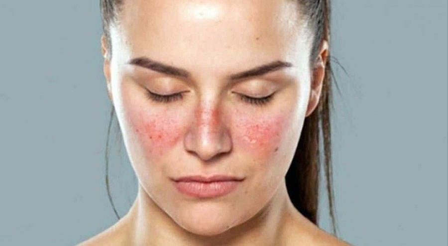 Encuesta global demuestra que el lupus tiene un gran impacto en la función física y la calidad de vida