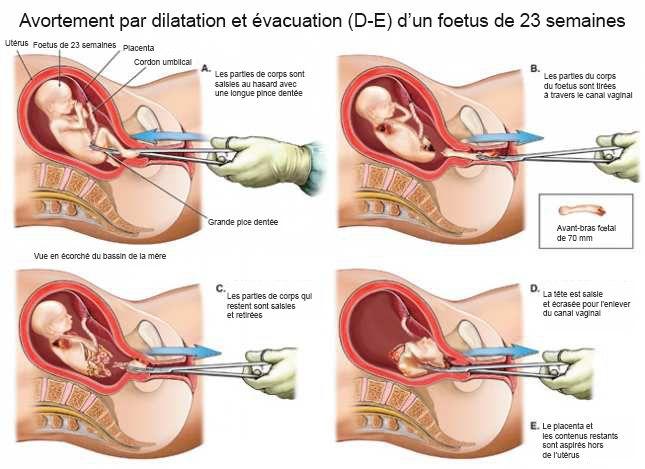 Canadá aporta $ 9 millones para salud reproductiva y aborto durante la pandemia