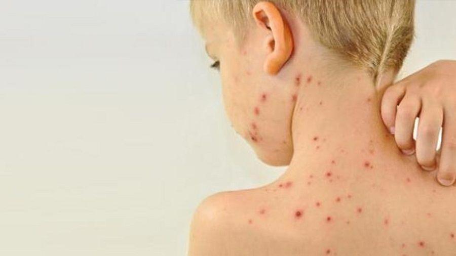 Argentina logró controlar el brote y es libre de sarampión