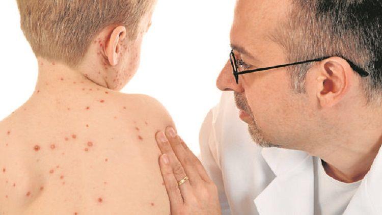 El gobierno de la Provincia de Buenos Aires anunció el cese del brote de sarampión