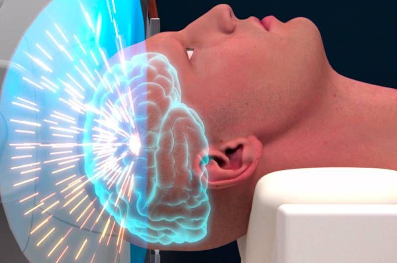 El Hospital Italiano realizó una cirugía de estimulación cerebral profunda para epilepsia refractaria