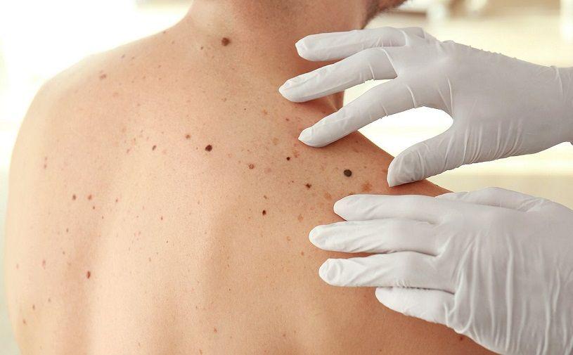 ´Los lunares están de moda´ campaña para incentivar el chequeo de lunares y prevenir el cáncer de piel