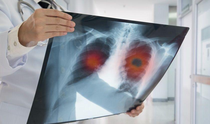 COVID-19: el daño pulmonar y cardíaco mejora con el tiempo