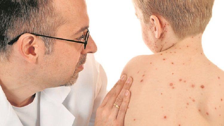 La OPS aprobó informe argentino sobre la interrupción de la transmisión del sarampión