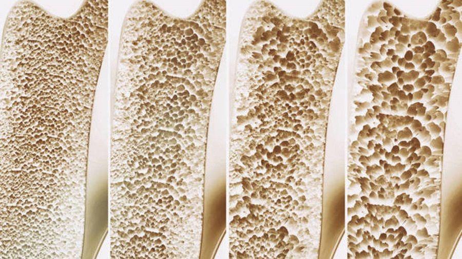 La pandemia incrementó la fragilidad en personas con osteoporosis