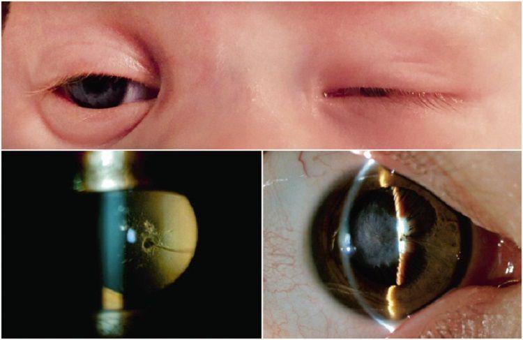 Arrojan pistas para el tratamiento de un agresivo tumor pediátrico