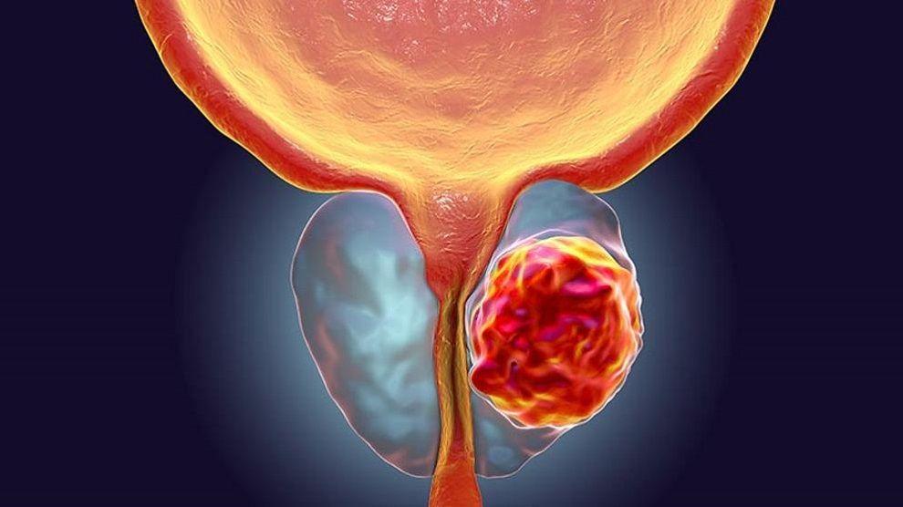 Noviembre azul: mes de la concientización sobre el cáncer de próstata