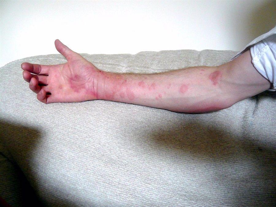 Mitos y verdades acerca de la urticaria crónica