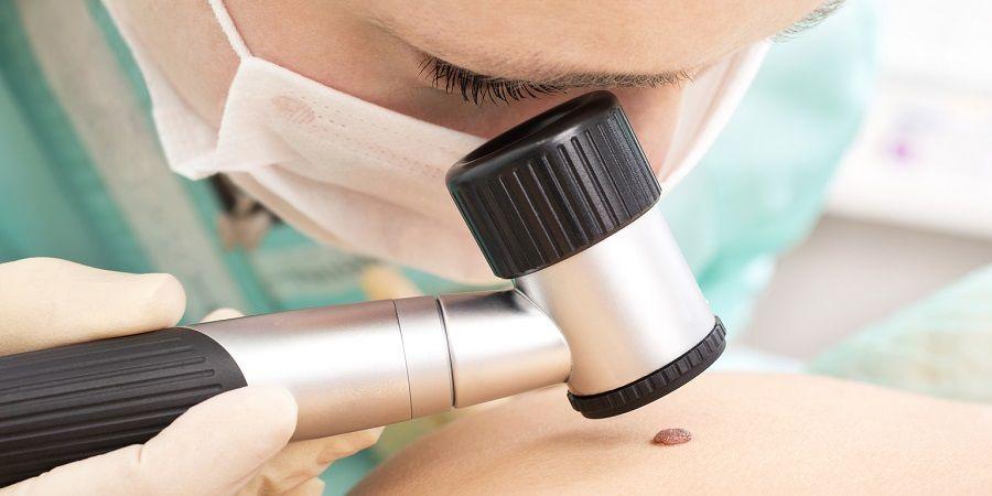 Cáncer de piel: recomiendan cuidarse durante todo el año y en especial los niños