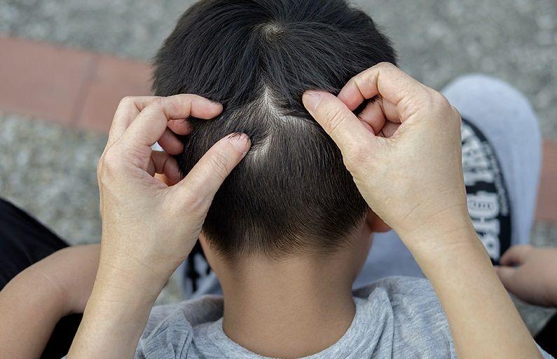 Por la pandemia, la prevalencia de pediculosis en argentina pasó de 70 al 44%