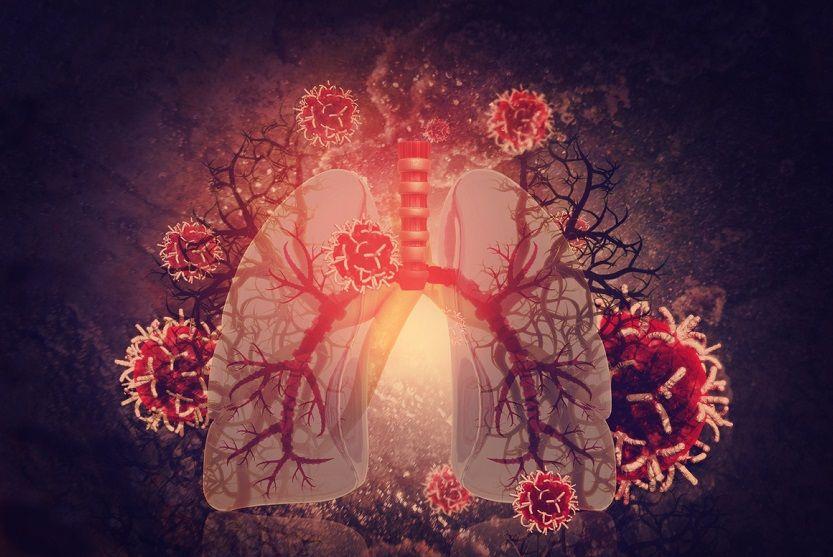 Identifican 70 genes de células pulmonares que se verían afectados durante la infección por COVID-19