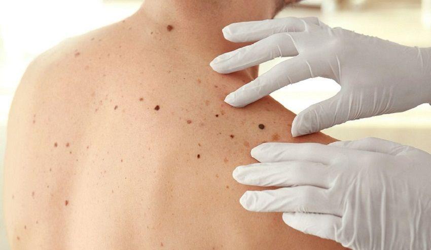 ¨Vamos al Punto¨: ¿Te chequeaste los lunares este año?