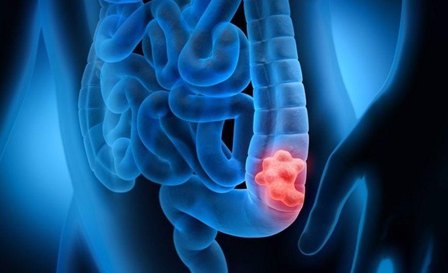 Tres estudios clave que detectan cáncer de colon a tiempo