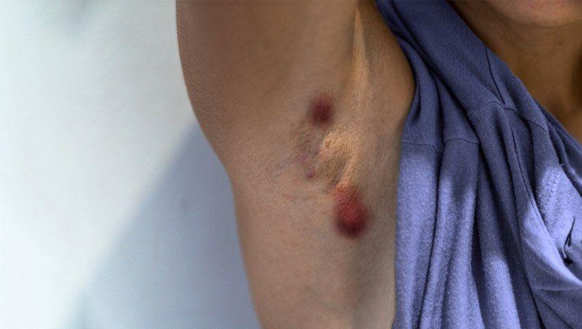 La SAD lanzó una campaña de detección gratuita de hidradenitis supurativa