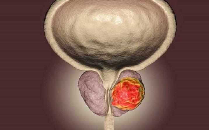 Nueva herramienta de inteligencia artificial para la detección precoz del cáncer de próstata