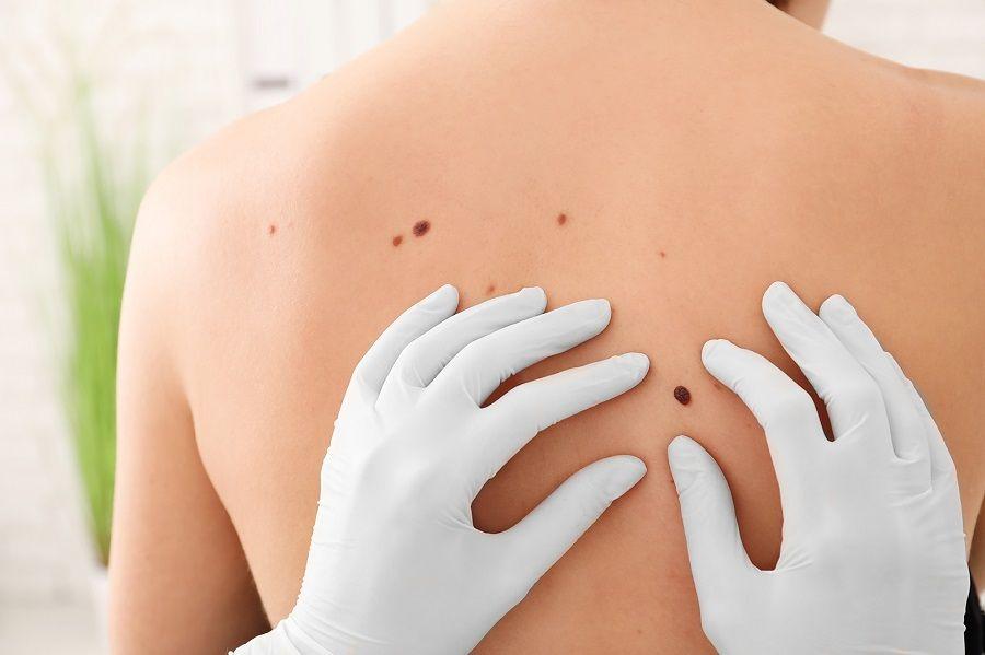 Advierten sobre la importancia de los estudios dermatológicos aún en invierno