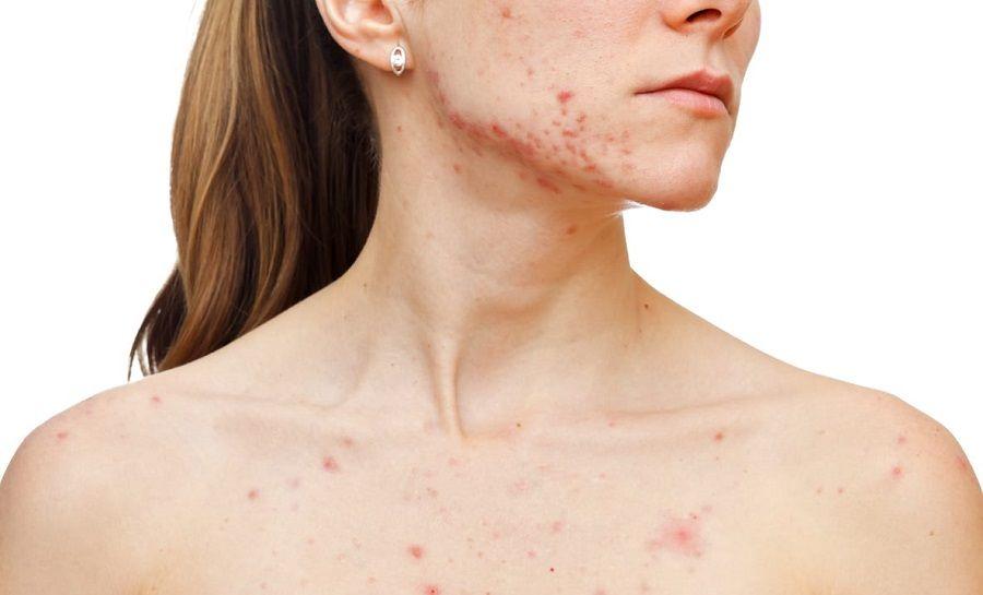 Linfoma T cutáneo: el diagnóstico precoz es crucial