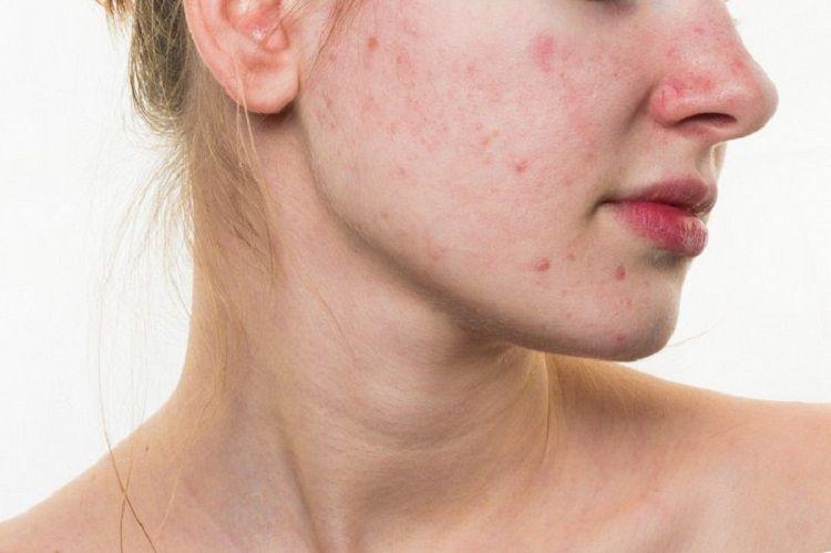 El acné tardío puede indicar trastornos hormonales