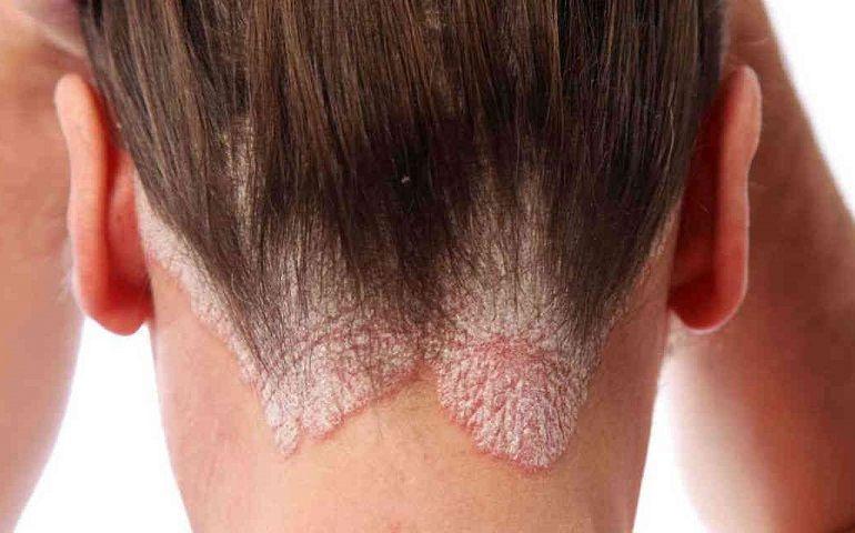 Claves para controlar la psoriasis