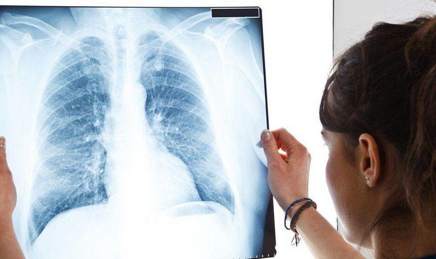 LONG COVID: las secuelas pulmonares que deja la enfermedad que pueden durar más de 12 meses