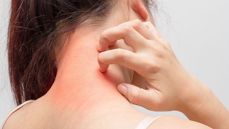 Dermatitis Atópica, un trastorno cutáneo que padecen entre un 15 y 30% de niños