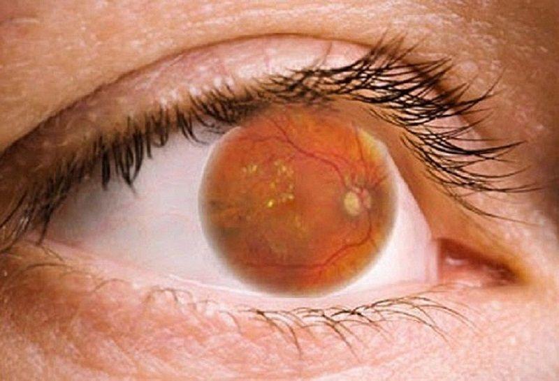 Los hombres con diabetes tipo 2 en edad temprana tienen mayor riesgo de retinopatía