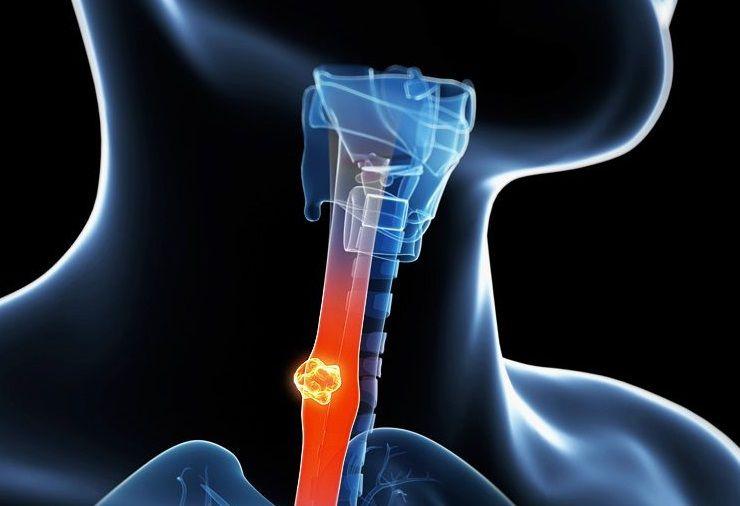 Los casos de cáncer de esófago se han triplicado entre los jóvenes en los últimos 30 años
