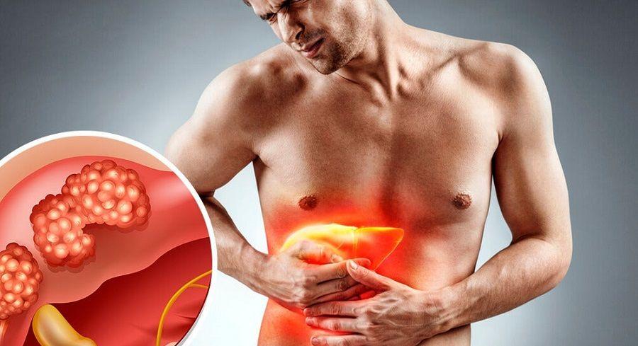 En Argentina se detectan 6 casos de cáncer de hígado por día