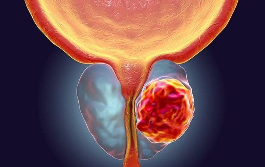 Nueva estrategia contra el cáncer de próstata resistente al tratamiento