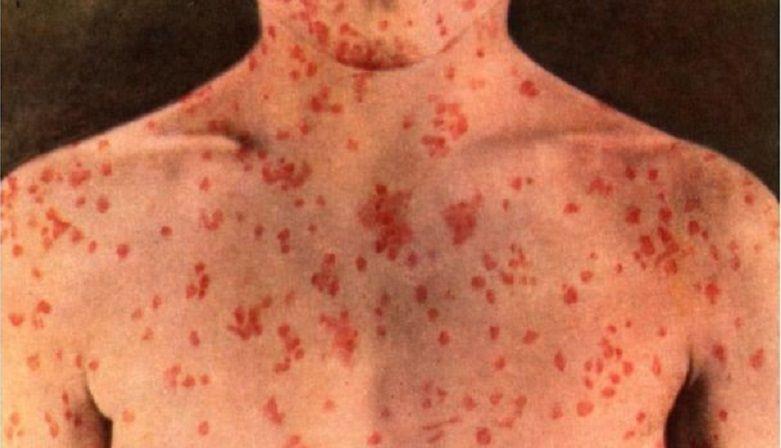 Salud alertó sobre el riesgo de reintroducción del virus de sarampión en nuestro país