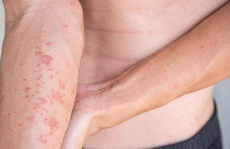 El impacto de la dermatitis atópica en los adolescentes durante los meses de calor