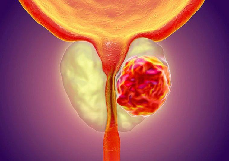 ANMAT aprobó un nuevo tratamiento para el cáncer de próstata