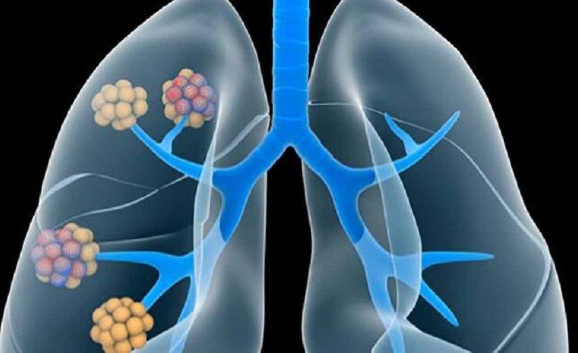 Hipertensión pulmonar: se considera dentro de las 7.000 enfermedades raras en el mundo