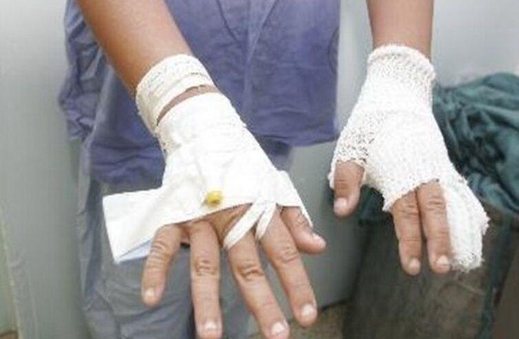 Pirotecnia: Cómo prevenir accidentes y qué hacer frente a una quemadura