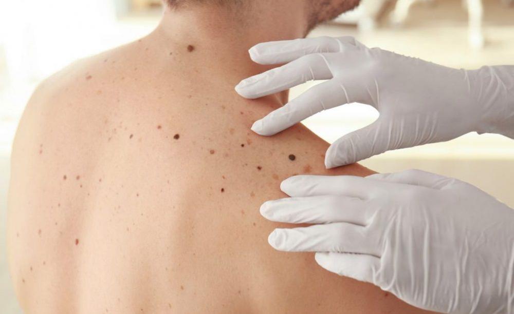 El cáncer de piel es el más común luego de los 40 años