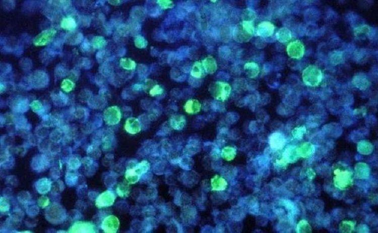 El virus de Epstein-Barr podría ser la causa principal de la esclerosis múltiple