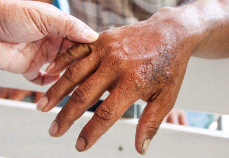 Enfermedad milenaria: todo lo que debes saber sobre la lepra