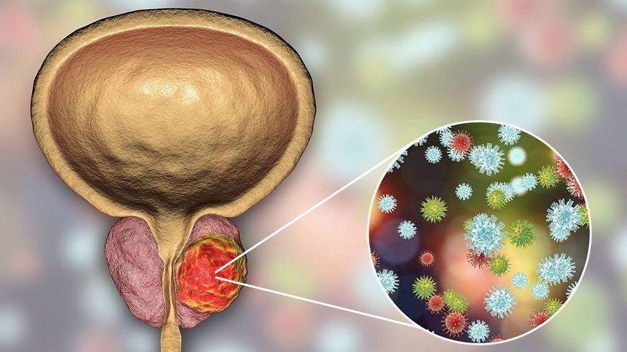 Identifican posible blanco terapéutico para el cáncer de próstata resistente a tratamientos hormonales